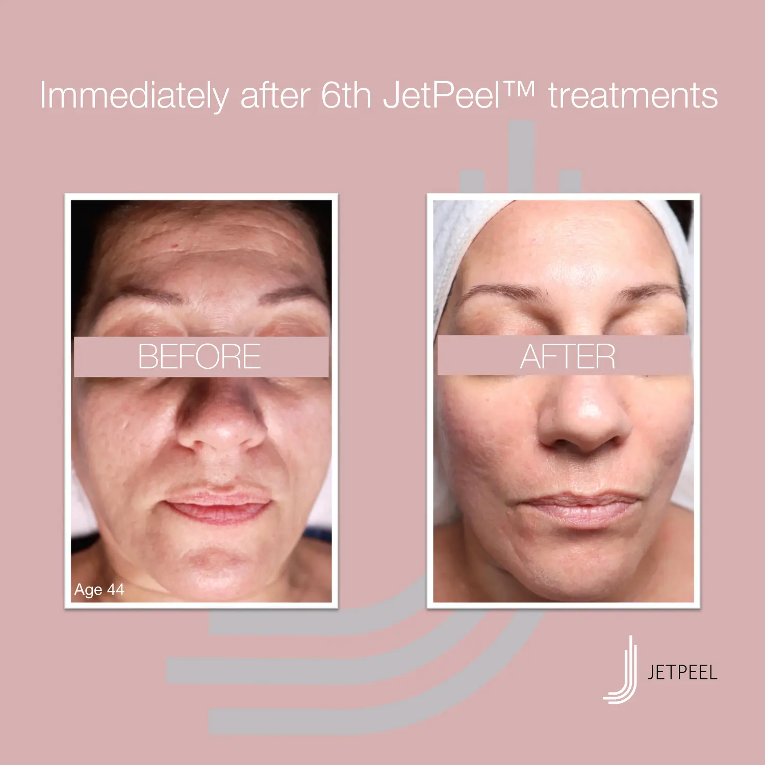Glatte Haut JetPeel