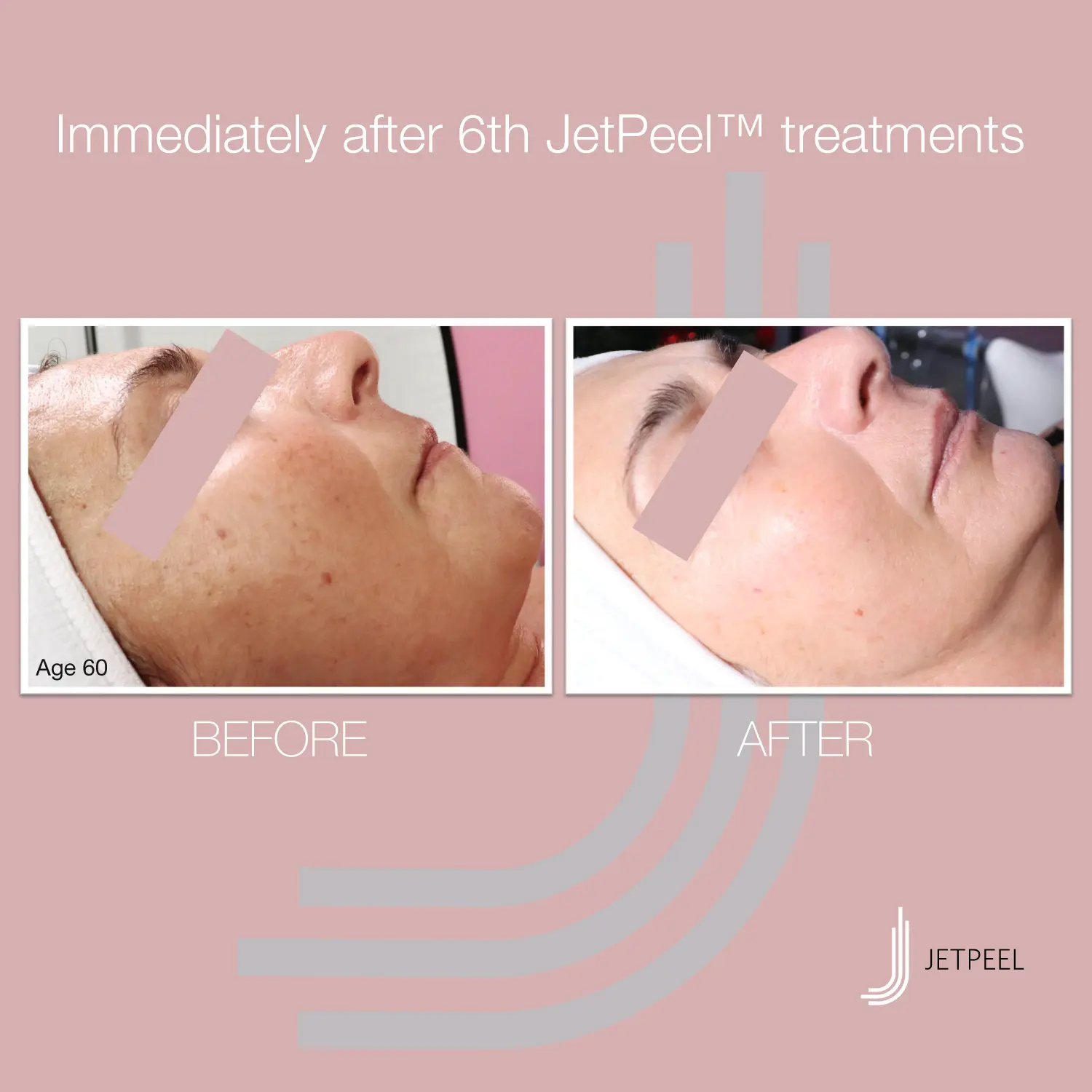 Jetpeel Behandlung für Glow