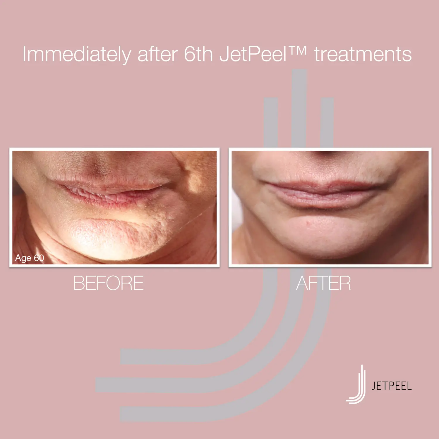 Lippen Falten und Fältchen Jetpeel Behandlung