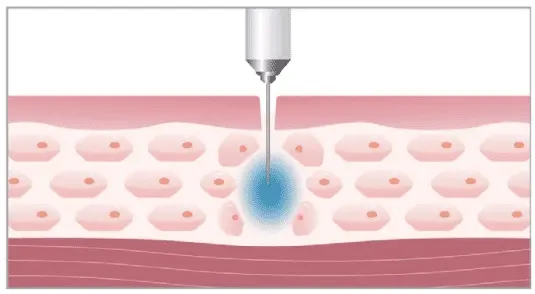 Nadel_Beispiel_Botox_Hyaluron_Filler